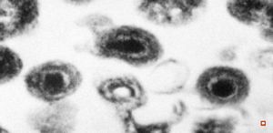 cytomegalovirus - pneumonia cytomegalovirus - pneumonia